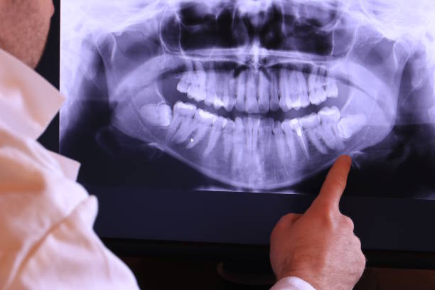 Best Emergency Wisdom Teeth Removal in Tornado, WV